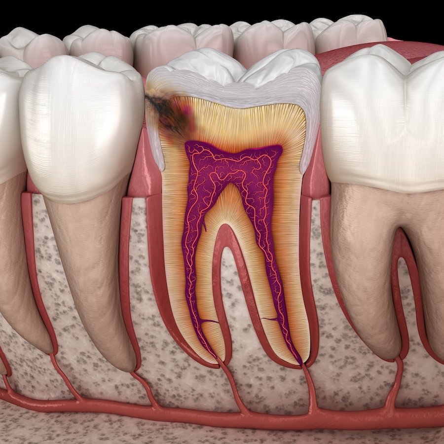 cavity progression, dental decay, oral hygiene, cavity prevention, Abidin and Cao DDS, Westerville, dental care, tooth decay stages, cavity treatment