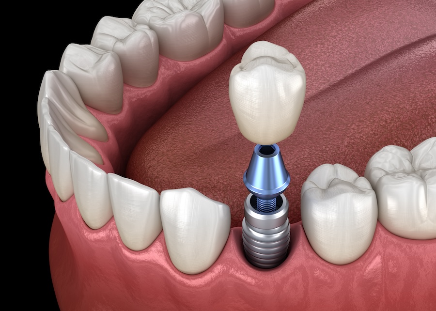 dentures, dental implants, tooth replacement, dentures vs implants, missing teeth, Westerville, dentures or dental implants, dentures or implants, implant supported dentures, missing teeth