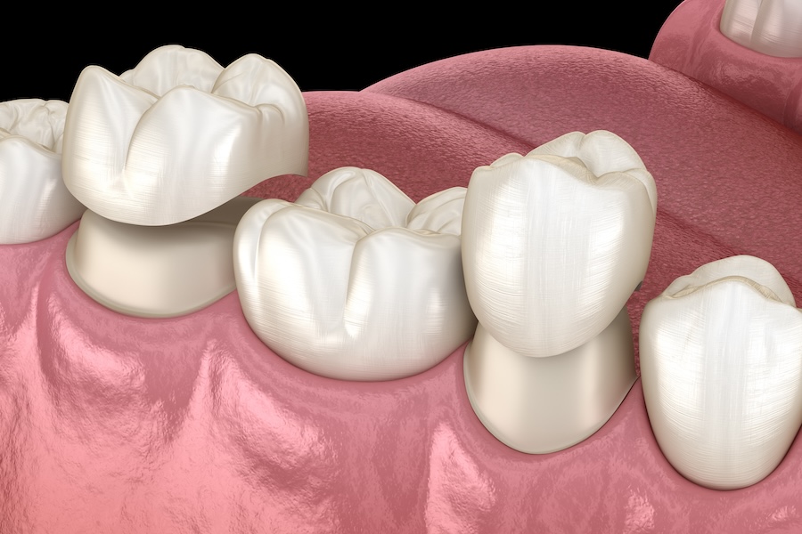 Illustration of dental crowns to show how they can restore damaged or chipped teeth at Abiding & Cao in Westerville